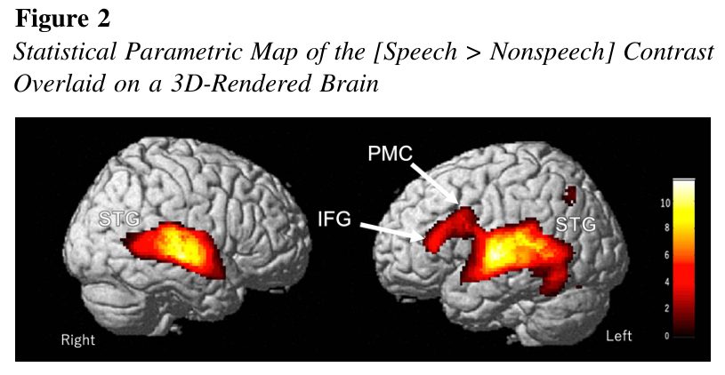 3D brain scan showing areas activated during speech processing, highlighting language learning potential.